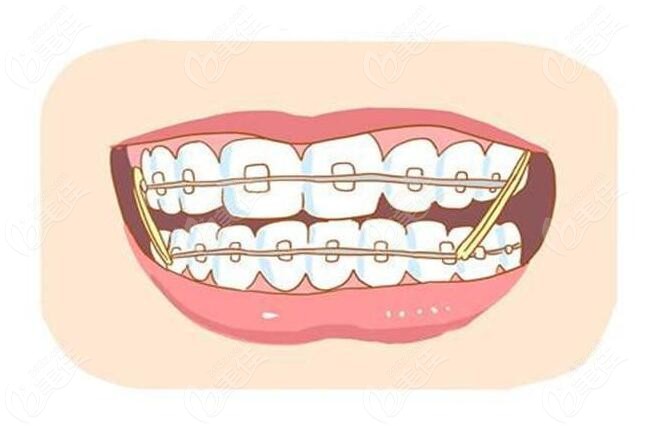 临沂牙齿矫正2024价格表:种植牙:6500元起/以色列dentin(丹因)种植牙价格:2000元起