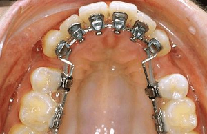 带牙箍矫正牙齿效果怎么样，这篇文章告诉你答案