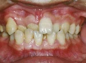 带牙箍矫正牙齿效果怎么样，这篇文章告诉你答案