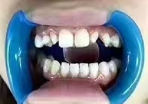 牙齿贴面和矫正冲突吗，牙贴面手术案例分析