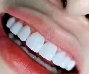 牙齿贴面和矫正冲突吗，牙贴面手术案例分析