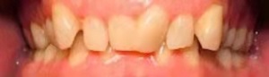 30岁矫正牙齿多久能看到效果，牙齿纠正前后对比