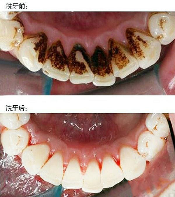 大同牙齿清洁2024价格表:瑞典尼奥斯种植牙价格:1800元起/德国贝格种植牙/颗:3900元起