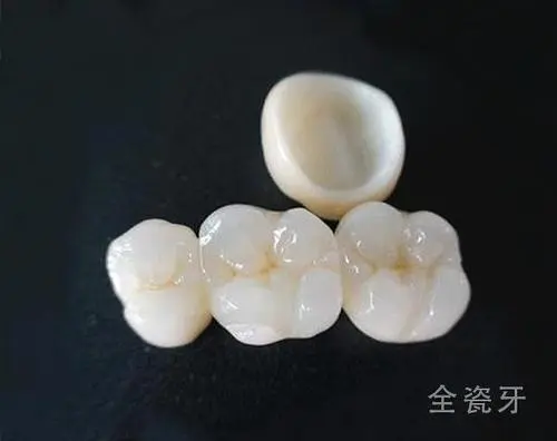 黄石瓷贴面2024价格表:美国皓圣种植牙:2000元起/瑞典astra种植牙:2700元起