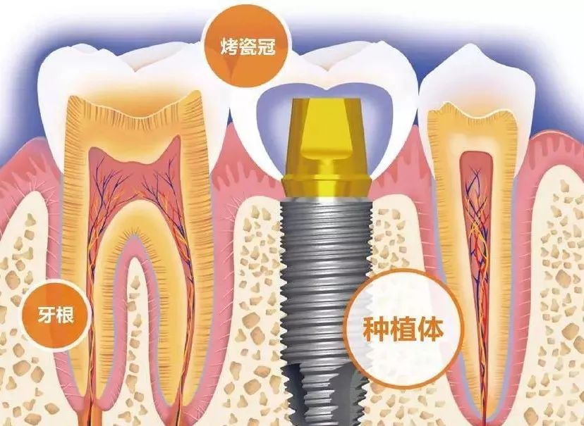 漯河种植牙2024价格表:德国费亚丹种植牙/颗:2500元起/美国皓圣种植牙价格:1800元起