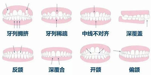 青岛冷光美白费用是多少呐(2024青岛冷光美白参考价为：1720元)