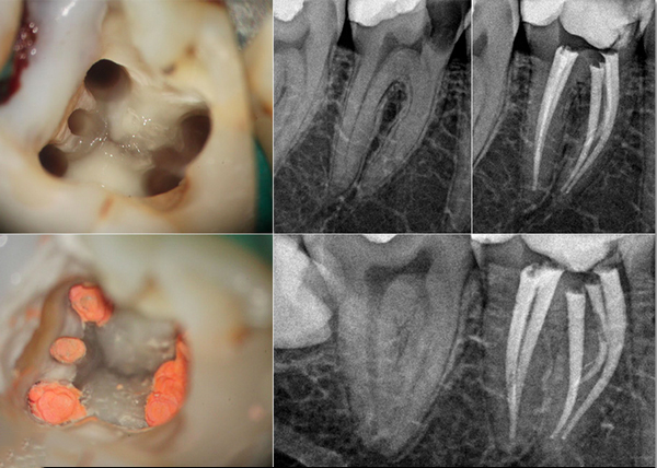 河源牙齿治疗2024价格表:以色列dentin(丹因)种植牙价格:2000元起/中年人种植牙:900元起