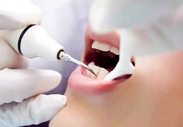 三门峡牙齿清洁2023价格表:以色列dentin(丹因)种植牙价格:2000元起/韩国登腾种植牙:800元起