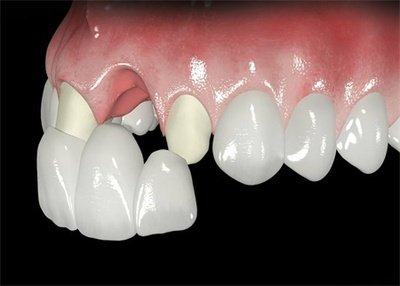 烤瓷牙影响做ct和核磁共振吗？影响，做ct、磁共振要拆下来