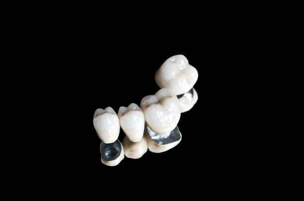 烤瓷牙掉了重新粘一下多少钱？拿下重新粘价格要50-500元起