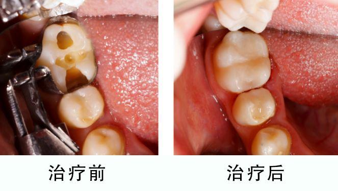 从徐州二院牙科价目表看徐州二院种植牙齿矫正、补牙费用
