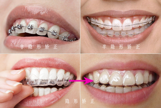 求问：拔牙掩饰性正畸后还能正颌吗？还可以正颌但价格较贵哦