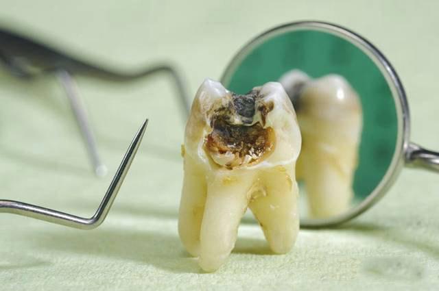 牙齿矫正扩弓好还是拔牙好？牙齿拥挤度＜10mm扩弓比拔牙好