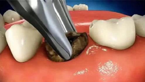 儿童乳牙滞留怎么办，拔牙or不拔牙宝妈们可晓得？