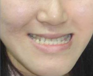 李继华正颌手术失败纯属谣言，某音好多李继华正颌手术实例
