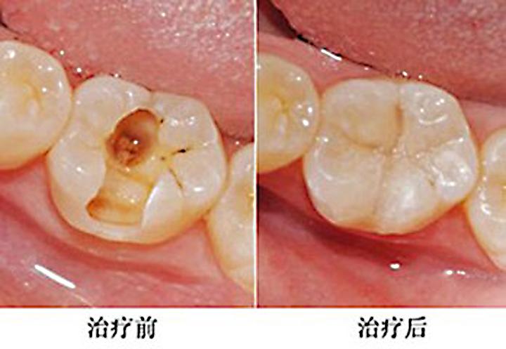 哈尔滨优诺口腔价格表：得知优诺口腔种植牙价格2480+补牙99+