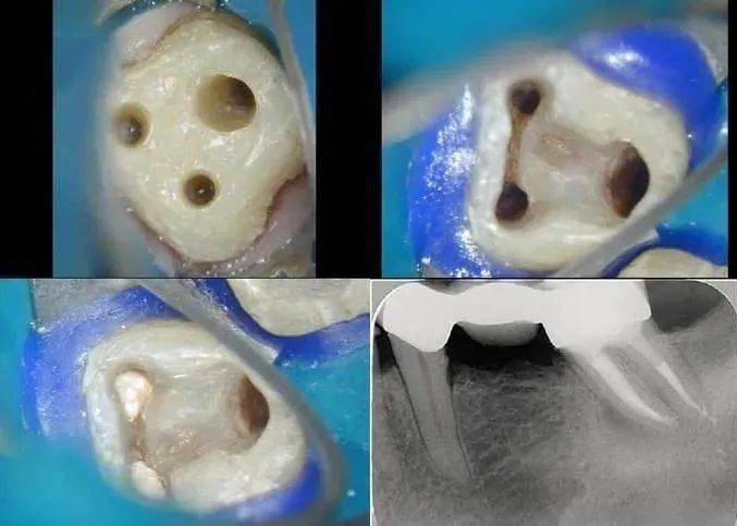 到底带牙冠的过程痛苦吗？还想知道戴全瓷冠的过程需要多久