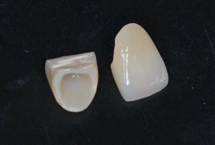威兰德全瓷牙1600元是真的吗？有可能是真的，但需要辨别真假