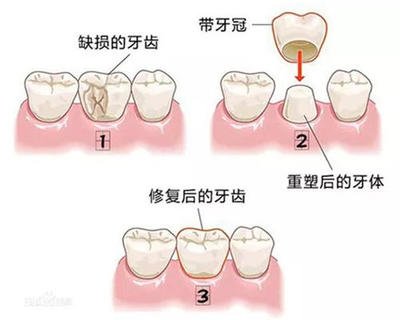 还在问一颗二氧化锆牙500贵吗？这有二氧化锆全瓷牙价格表哟