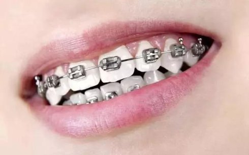 超声波洁牙、喷砂洁牙、抛光洁牙哪个好？怎么选有答案了