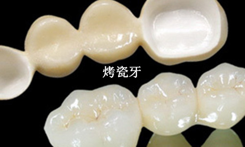 进口十大较好全瓷牙品牌排行：德国威兰德、韩国登腾全瓷牙冠