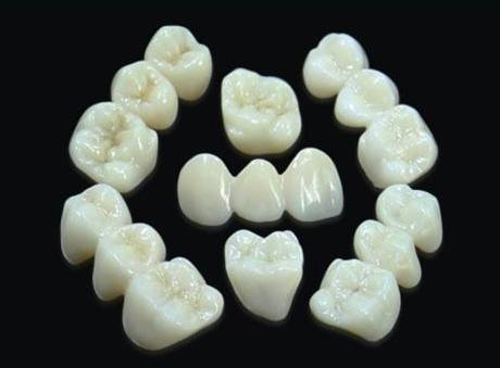 瑞典procera全瓷牙能用30年+，虽价格比lava贵但质量比威兰德好