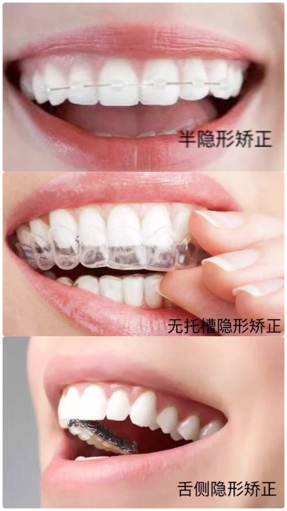 成人牙齿矫正，是担心反弹还是怕戴牙套费用高？