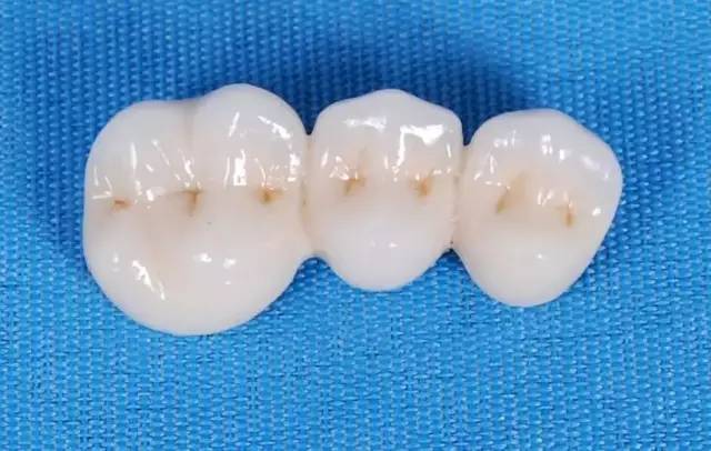 介绍灵犀瓷贴面怎么样？含进口灵犀贴面材料+价格+特点了解