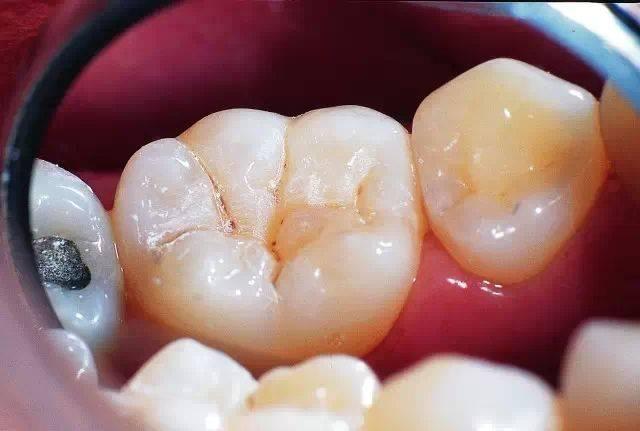 门牙缺失了不种没有其他办法了吗？有镶牙方法、可镶完很绝望