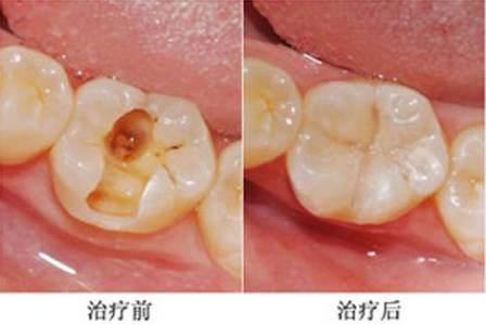 拔牙好几年了还能种牙吗？可以，但要符合种植牙条件
