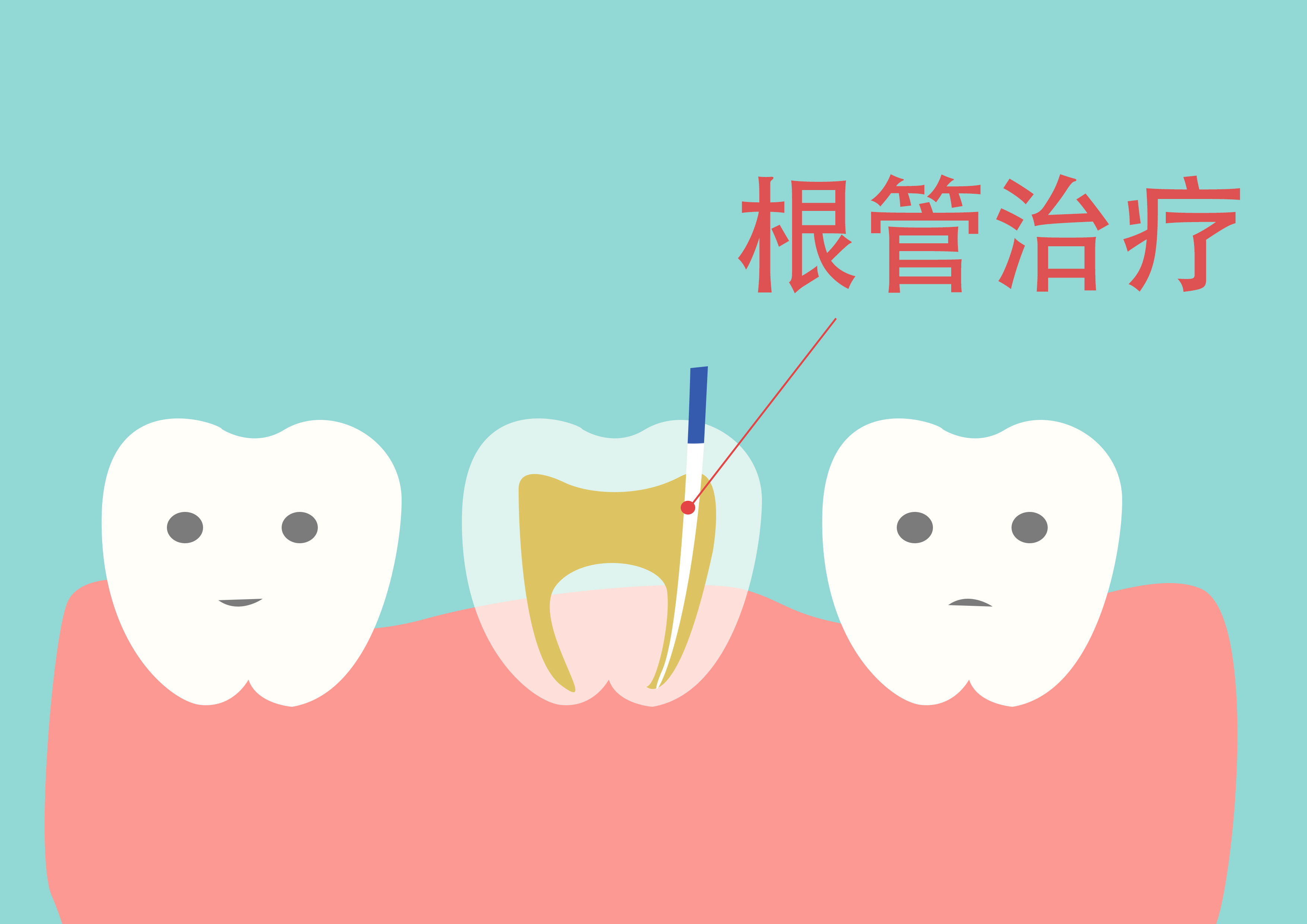 根管治疗6年后又发炎了，二次根管难度大，治疗好还是拔了好？