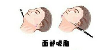 西安艺星医疗美容医院（西北旗舰店）整形外科怎么样？附上鼻部整形案例分享+门诊时间