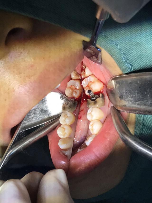 濮阳雅美口腔牙齿种植实力曝光：二十年临床经验团队带来安心诊疗体验