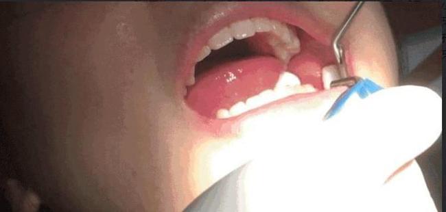 合肥丽华口腔牙齿矫正全记录:告别深覆合的好蜕变