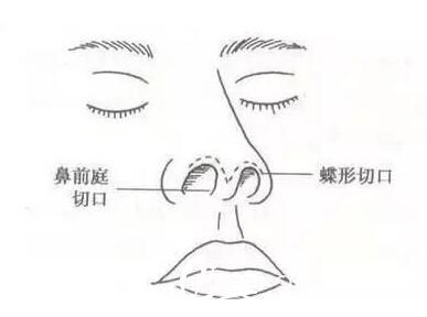 北京画美医疗美容医院鼻部整形怎么样?真实案例与专业解读