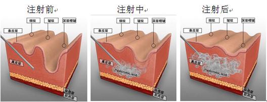 在重庆多家机构仔细对比后较终选择李红萍口腔进行玻尿酸祛泪沟