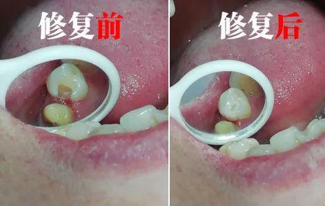 嘉兴平湖复尔口腔价格表：种植牙7000+牙齿矫正9000+镶牙1000+