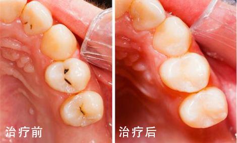 荆门小白兔口腔维乐龙泉店牙齿矫正价格表:含金属自锁与隐形矫正费用