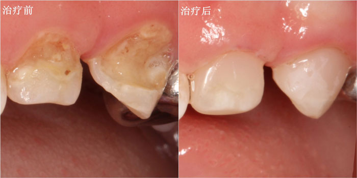 东莞君诺口腔收费标准详解:包含牙齿矫正与种植牙等项目价格