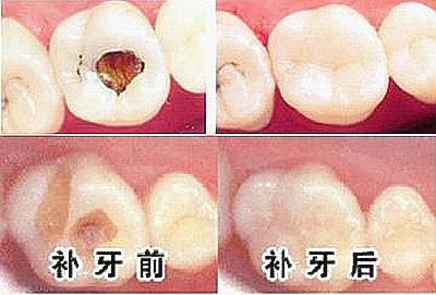 南充华医口腔收费标准明细：牙齿矫正7305起+种牙6500+补牙1153+