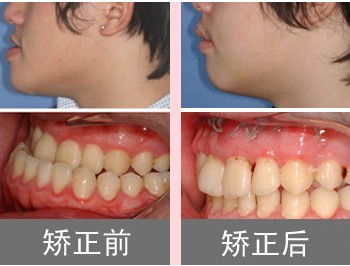永州安牙舒口腔详解地包天矫正:如何分辨骨性与牙性及矫正方案选择