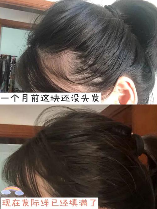 如何打造理想发际线种植发际线与纹发际线全方位对比指南