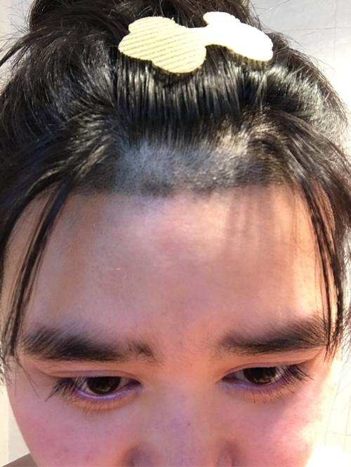 如何打造理想发际线种植
