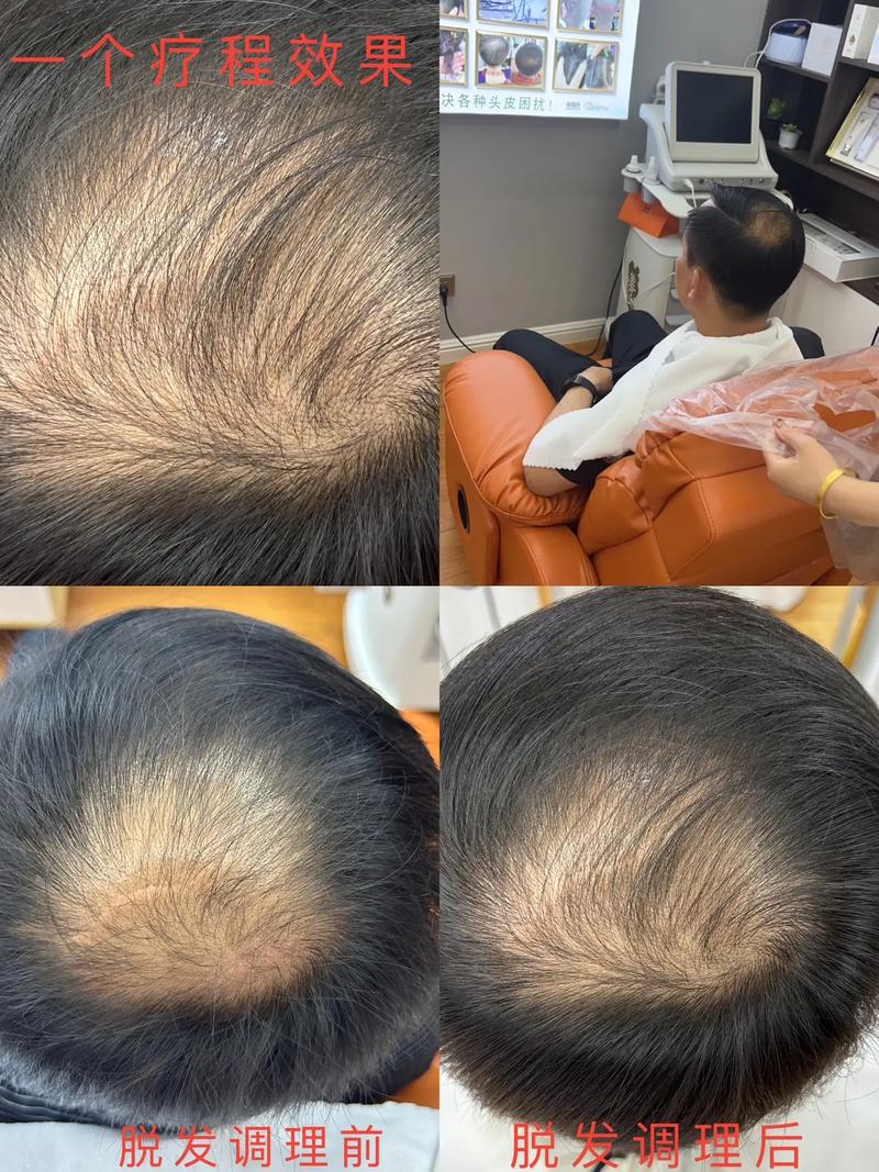 如何打造理想发际线种植发际线与纹发际线全方位对比指南