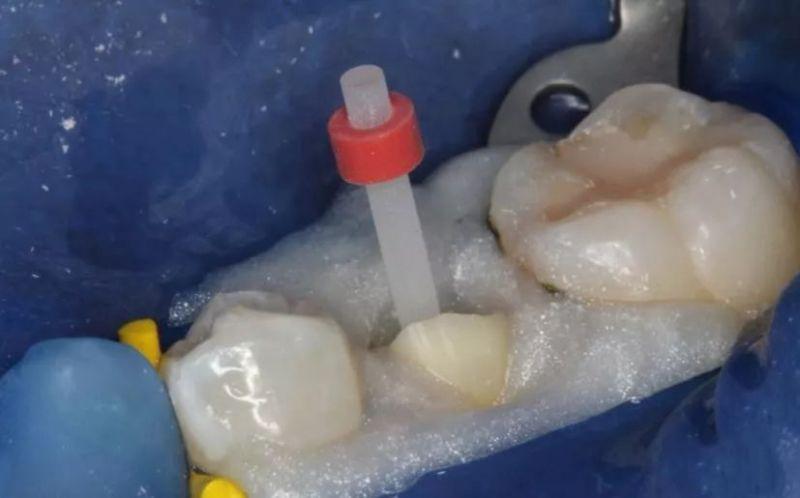 德阳德贝口腔种植牙价格是多少?单颗6800丨半口4.5万丨全口9.8万起
