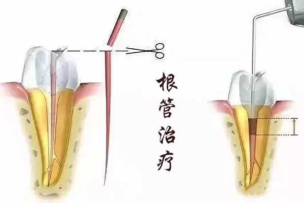 烟台胶东半岛口腔解析:根管治疗后必须做种植牙吗?真相让人意外