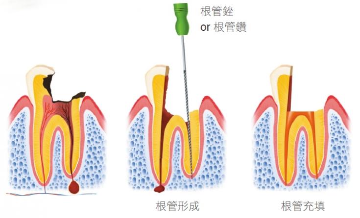 永州牙博士口腔医院专家解析大牙烂掉只剩空壳的修复方案