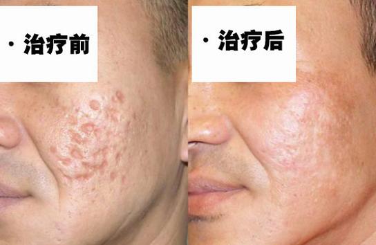 阜阳壹加壹医疗美容疤痕修复怎么样?疤痕修复案例分享