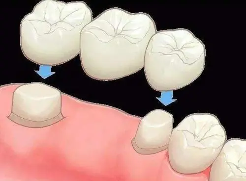 北京优贝口腔贵金属烤瓷牙修复技术怎么样?价格贵不贵?
