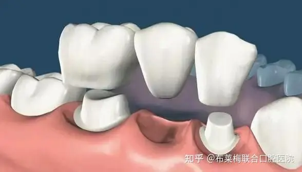 北京圣贝口腔贵金属烤瓷牙价格表公开!11419元起丨专业医师团队介绍